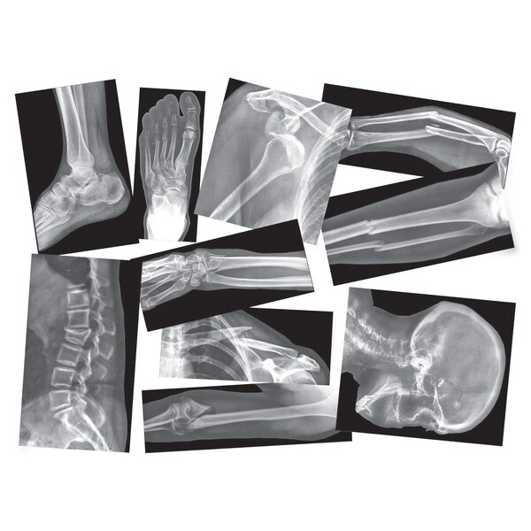 Broken Bones X-Ray Set, 15 Pieces